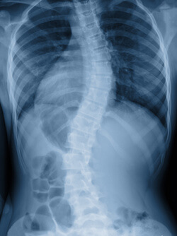 x-ray of spine