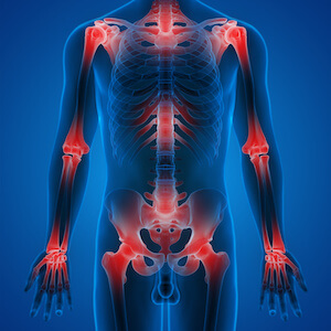 outline of skeleton showing regions of inflammation