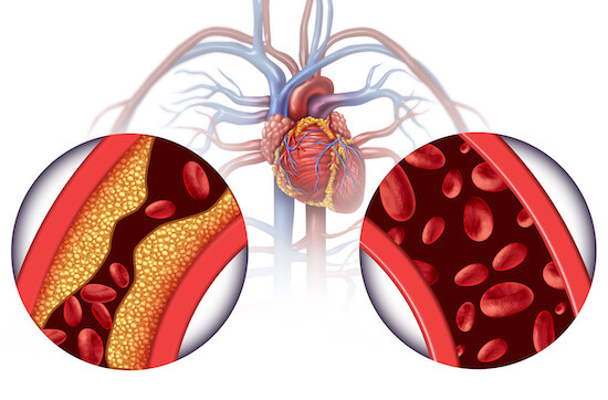 Chelation Therapy