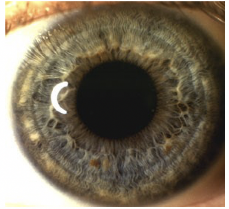 What is an Iris Analysis? An Optimal You