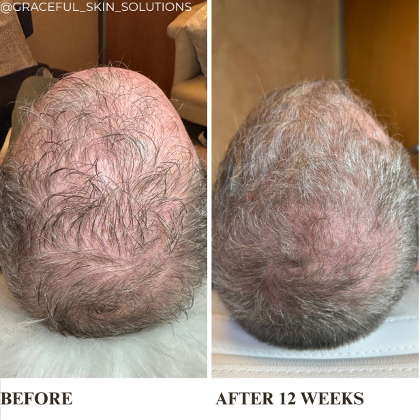 PRP Hair Rejuvenation A Natural Next-Level Approach