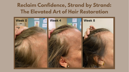 Reclaim Confidence Strand by Strand The Elevated Art of Hair Restoration